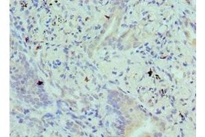 Immunohistochemistry of paraffin-embedded human lung cancer using ABIN7145292 at dilution of 1:100 (BIK antibody  (AA 1-130))