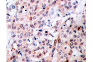 Immunohistochemistry of paraffin-embedded Human breast carcinoma tissue, using Phospho-Bcl-2(T56) Polyclonal Antibody (Bcl-2 antibody  (pThr56))