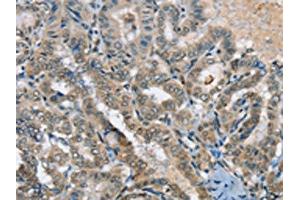 The image on the left is immunohistochemistry of paraffin-embedded Human thyroid cancer tissue using ABIN7192312(SEPN1 Antibody) at dilution 1/20, on the right is treated with synthetic peptide. (Selenoprotein N antibody)