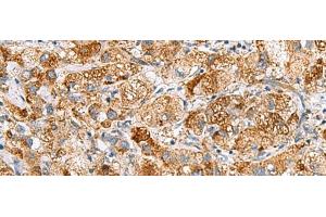 Immunohistochemistry of paraffin-embedded Human liver cancer tissue using NMU Polyclonal Antibody at dilution of 1:80(x200) (Neuromedin U antibody)