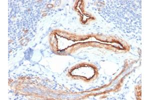 Formalin-fixed, paraffin-embedded human Renal Cell Carcinoma stained with MTF1 Mouse Monoclonal Antibody (MTF1/2649).