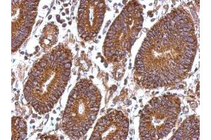 IHC-P Image Immunohistochemical analysis of paraffin-embedded human colon carcinoma, using Laminin beta 1, antibody at 1:500 dilution. (Laminin beta 1 antibody  (C-Term))