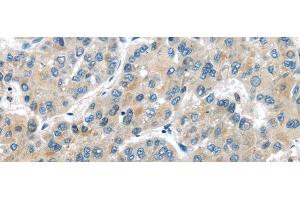 Immunohistochemistry of paraffin-embedded Human liver cancer tissue using MASP2 Polyclonal Antibody at dilution 1:35 (MASP2 antibody)