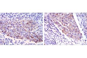 Immunohistochemical analysis of paraffin-embedded human cervical cancer tissues (left) and human kidney cancer tissues (right) using MMP1 mouse mAb with DAB staining. (MMP1 antibody)