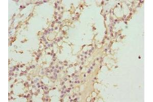 Immunohistochemistry of paraffin-embedded human breast cancer using ABIN7144903 at dilution of 1:100 (ABCC11 antibody  (AA 1-170))
