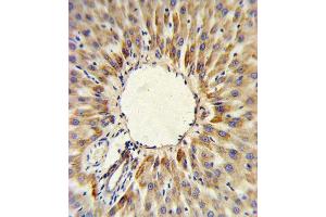 HMGCS2 Antibody (C-term) (ABIN390764 and ABIN2841022) IHC analysis in formalin fixed and paraffin embedded human hepatocarcinoma followed by peroxidase conjugation of the secondary antibody and DAB staining. (HMGCS2 antibody  (C-Term))