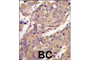 Formalin-fixed and paraffin-embedded breast carcinoma tissue reacted with UBE2L6 Antibody , which was peroxidase-conjugated to the secondary antibody, followed by DAB staining. (UBE2L6 antibody  (C-Term))