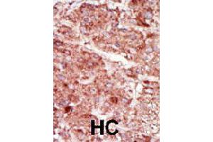 Formalin-fixed and paraffin-embedded human hepatocellular carcinoma tissue reacted with HK3 polyclonal antibody  , which was peroxidase-conjugated to the secondary antibody, followed by AEC staining. (HK3 antibody  (C-Term))