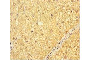 Immunohistochemistry of paraffin-embedded human liver cancer using ABIN7147035 at dilution of 1:100