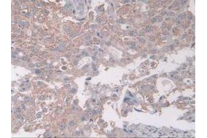 IHC-P analysis of Human Breast Cancer Tissue, with DAB staining. (Coxsackie Adenovirus Receptor antibody  (AA 20-229))
