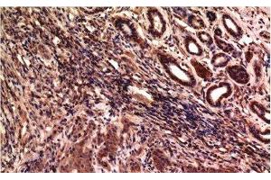 Immunohistochemistry of paraffin-embedded Human breast carcinoma tissue using gamma Tubulin Monoclonal Antibody at dilution of 1:200. (TUBG1 antibody)