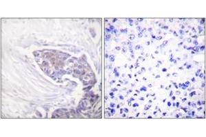 Immunohistochemistry analysis of paraffin-embedded human breast carcinoma tissue, using TRXR2 Antibody. (TXNRD2 antibody  (AA 471-520))