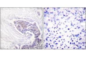 Immunohistochemistry analysis of paraffin-embedded human breast carcinoma tissue, using TRXR2 Antibody.