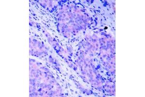 Immunohistochemistry of paraffin-embedded human breast carcinoma tissue, using Phospho-PDPK1-S241 antibody (ABIN2988238). (PDPK1 antibody  (pSer241))
