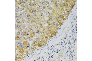Immunohistochemistry of paraffin-embedded human liver cancer using PA2G4 Antibody (ABIN5973112) at dilution of 1/100 (40x lens). (PA2G4 antibody)