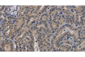 Immunohistochemistry of paraffin-embedded Human thyroid cancer tissue using TAB1 Polyclonal Antibody at dilution 1:40 (TAB1 antibody)