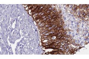 ABIN6268717 at 1/100 staining Human urothelial cancer tissue by IHC-P.