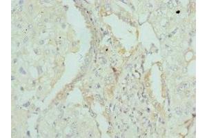 Immunohistochemistry of paraffin-embedded human lung cancer using ABIN7144441 at dilution of 1:100 (Apolipoprotein M antibody  (AA 23-188))