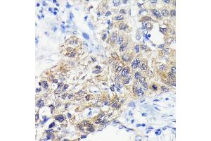 Immunohistochemistry of paraffin-embedded human lung cancer using  antibody (ABIN7265709) at dilution of 1:100 (40x lens).