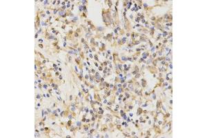 Immunohistochemistry of paraffin-embedded human lung cancer using ATG5 antibody (ABIN4902970) at dilution of 1:100 (40x lens). (ATG5 antibody)