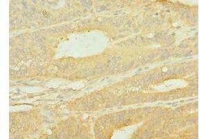 Immunohistochemistry of paraffin-embedded human endometrial cancer using ABIN7156048 at dilution of 1:100 (SLC1A2 antibody  (AA 306-348))