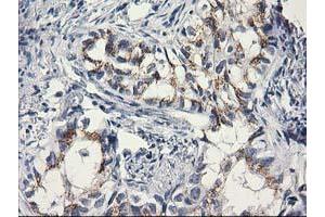 Immunohistochemical staining of paraffin-embedded Carcinoma of Human lung tissue using anti-C1orf50 mouse monoclonal antibody.