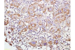 Paraformaldehyde-fixed, paraffin embedded human liver cancer, Antigen retrieval by boiling in sodium citrate buffer (pH6) for 15min, Block endogenous peroxidase by 3% hydrogen peroxide for 30 minutes, Blocking buffer (normal goat serum) at 37°C for 20min, Antibody incubation with GRP75 Polyclonal Antibody, Unconjugated  at 1:500 overnight at 4°C, followed by a conjugated secondary and DAB staining. (HSPA9 antibody  (AA 561-679))