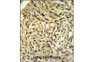 FKBP14 Antibody IHC analysis in formalin fixed and paraffin embedded human Lung carcinoma followed by peroxidase conjugation of the secondary antibody and DAB staining. (FKBP14 antibody  (N-Term))