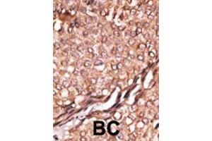 Formalin-fixed and paraffin-embedded human cancer tissue reacted with the primary antibody, which was peroxidase-conjugated to the secondary antibody, followed by AEC staining. (BAIAP2 antibody  (C-Term))