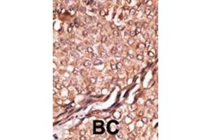 Formalin-fixed and paraffin-embedded human cancer tissue reacted with the primary antibody, which was peroxidase-conjugated to the secondary antibody, followed by AEC staining.