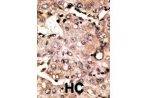 Formalin-fixed and paraffin-embedded human cancer tissue reacted with the primary antibody, which was peroxidase-conjugated to the secondary antibody, followed by DAB staining. (ATG4D antibody  (C-Term))