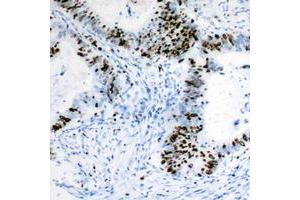 Immunohistochemical analysis of RB1 staining in human colon cancer formalin fixed paraffin embedded tissue section. (Retinoblastoma 1 antibody  (C-Term))