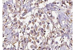 ABIN6277027 at 1/100 staining Human breast cancer tissue by IHC-P. (EXT1 antibody)