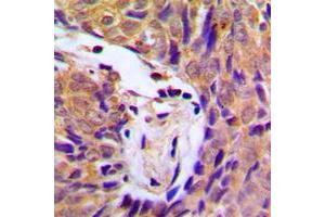 Immunohistochemical analysis of IKK alpha/beta (pS180/181) staining in human breast cancer formalin fixed paraffin embedded tissue section. (IKK-alpha /IKK-beta antibody  (pSer180, pSer181))