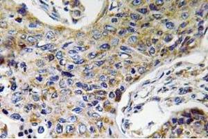 Immunohistochemistry (IHC) analyzes of ATP5J2 antibody in paraffin-embedded human lung carcinoma tissue. (ATP5J2 antibody  (Subunit F))