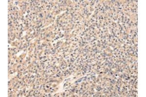 The image on the left is immunohistochemistry of paraffin-embedded Human breast cancer tissue using ABIN7128083(VIP Antibody) at dilution 1/20, on the right is treated with fusion protein. (Vip antibody)