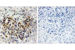 Peptide - +Immunohistochemistry analysis of paraffin-embedded human breast carcinoma tissue, using IRX3 antibody. (IRX3 antibody)
