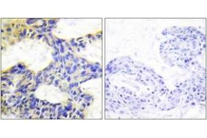 Immunohistochemistry analysis of paraffin-embedded human breast carcinoma tissue, using S6K Antibody. (RPS6KB1 antibody  (AA 261-310))