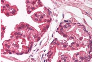 Human Prostate (formalin-fixed, paraffin-embedded) stained with NFIA antibody ABIN214127 at 5 ug/ml followed by biotinylated goat anti-rabbit IgG secondary antibody ABIN481713, alkaline phosphatase-streptavidin and chromogen. (NFIA antibody  (AA 348-397))