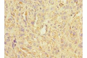Immunohistochemistry of paraffin-embedded human melanoma using ABIN7143004 at dilution of 1:100 (ASIC3 antibody  (AA 62-320))