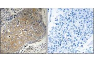 Immunohistochemistry analysis of paraffin-embedded human lung carcinoma tissue, using MRPS33 Antibody. (MRPS33 antibody  (AA 51-100))