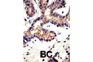 Formalin-fixed and paraffin-embedded human cancer tissue reacted with UBQLN3 polyclonal antibody  , which was peroxidase-conjugated to the secondary antibody, followed by DAB staining . (Ubiquilin 3 antibody  (N-Term))