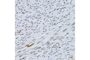 Immunohistochemistry of paraffin-embedded human uterine cancer using SNRNP70 antibody. (SNRNP70 antibody  (AA 150-250))