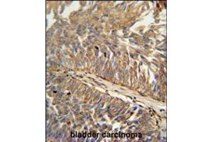 ATP13A3 antibody immunohistochemistry analysis in formalin fixed and paraffin embedded human bladder carcinoma followed by peroxidase conjugation of the secondary antibody and DAB staining. (ATP13A3 antibody  (N-Term))