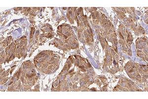 ABIN6275896 at 1/100 staining Human Melanoma tissue by IHC-P. (FAM3D antibody  (C-Term))