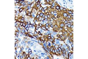 Immunohistochemistry of paraffin-embedded human lung cancer using WNT5A Rabbit mAb (ABIN7271378) at dilution of 1:100 (40x lens).