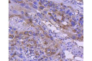 Paraformaldehyde-fixed, paraffin embedded human lung carcinoma, Antigen retrieval by boiling in sodium citrate buffer (pH6) for 15min, Block endogenous peroxidase by 3% hydrogen peroxide for 30 minutes, Blocking buffer (normal serum) at 37°C for 20min, Antibody incubation with IRF5 (3F11) Monoclonal Antibody  at 1:50 overnight at 4°C, followed by a conjugated secondary and DAB staining. (IRF5 antibody)