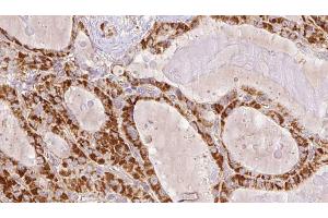 ABIN6267202 at 1/100 staining Human thyroid cancer tissue by IHC-P.