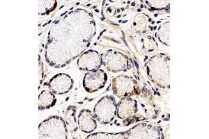 Immunohistochemistry of paraffin embedded human gastric cancer using ANKK1 (ABIN7073056) at dilution of 1:200 (400x lens) (ANKK1 antibody)