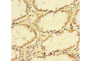 Immunohistochemistry of paraffin-embedded human colon cancer using ABIN7173655 at dilution of 1:100 (TUBA1B antibody  (AA 29-310))